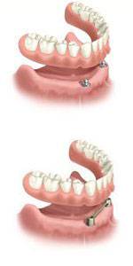 Precise Dentures–Blair Grundy Denture Clinic - Australian Directory 2