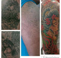 Laserpro Tattoo Removal - Australian Directory