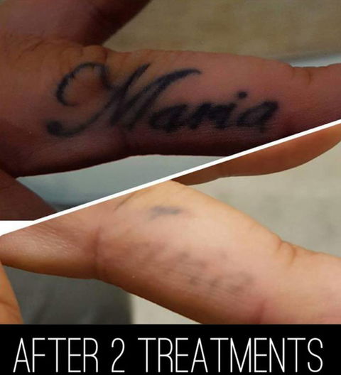 Laserpro Tattoo Removal - Australian Directory 2