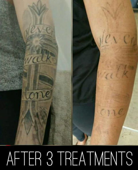 Laserpro Tattoo Removal - Australian Directory 3