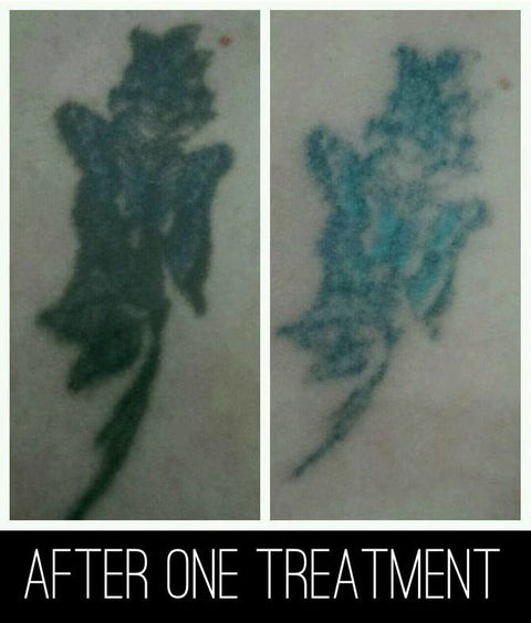 Laserpro Tattoo Removal - Australian Directory 4